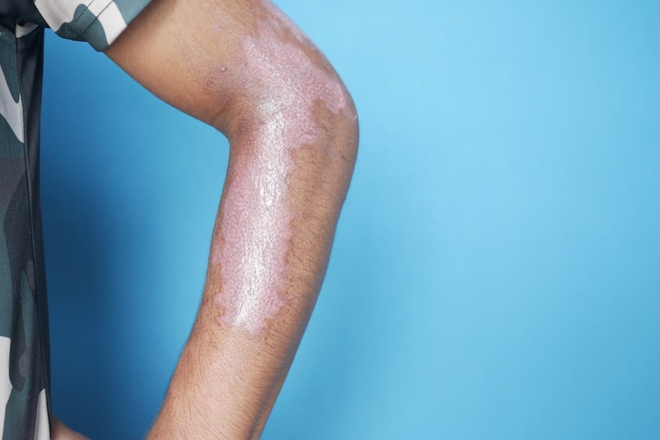 Tratamiento de la Psoriasis 2
