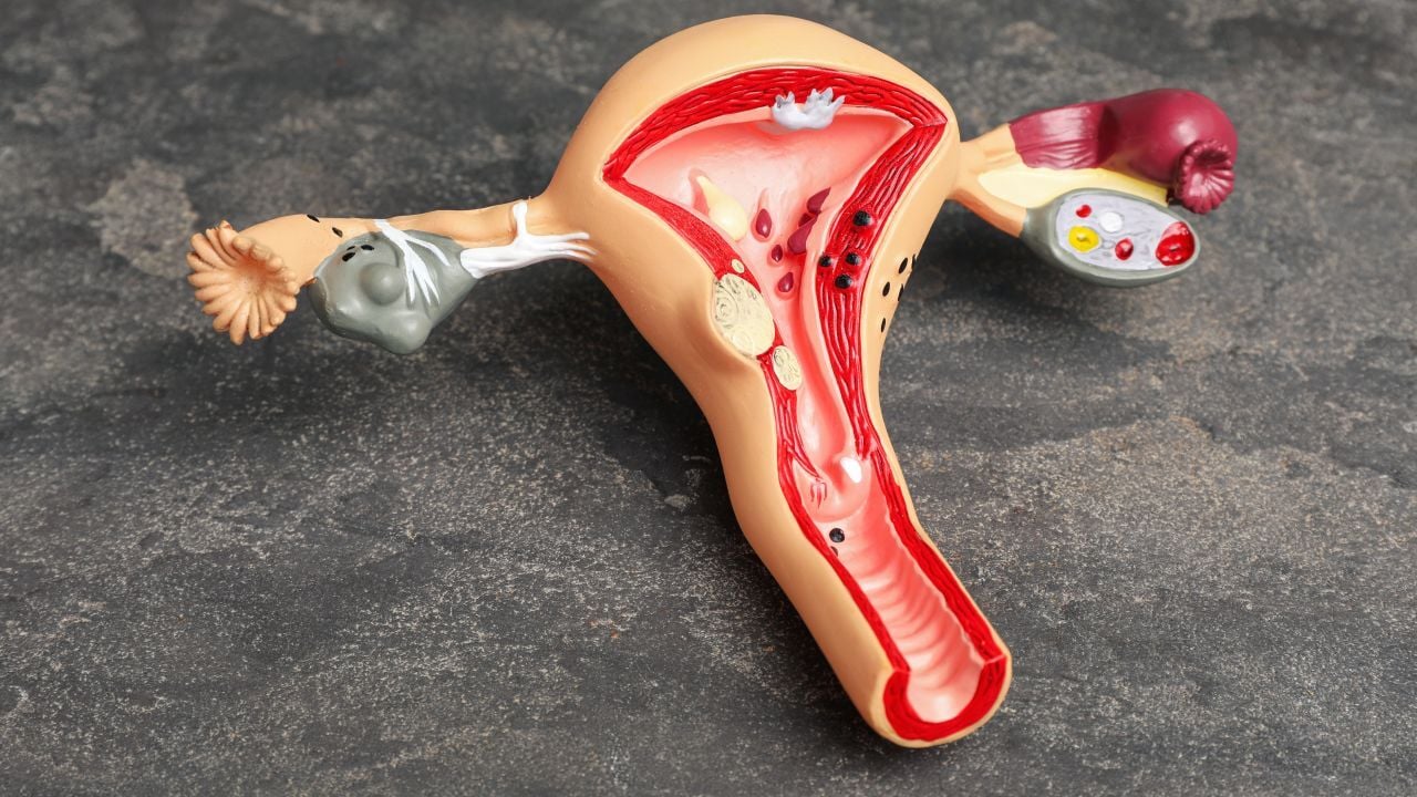 beneficios de la ablacion endometrial