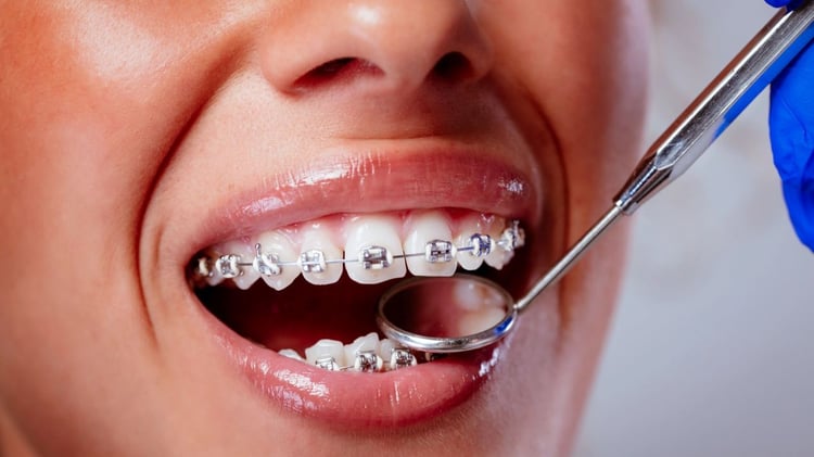 como cuidar los dientes con brackets