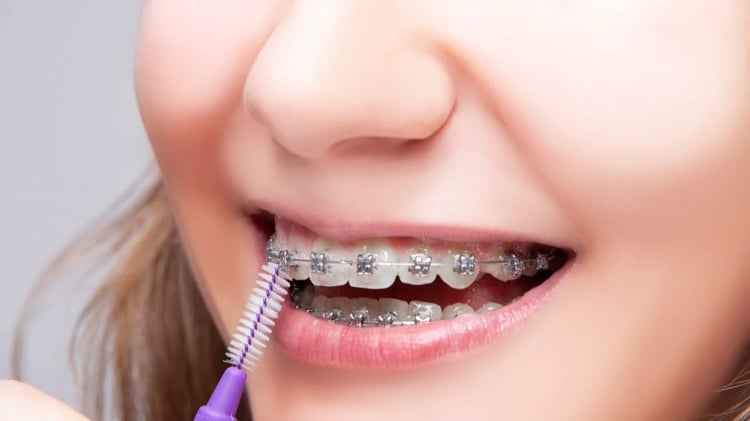 como limpiar los dientes con brackets
