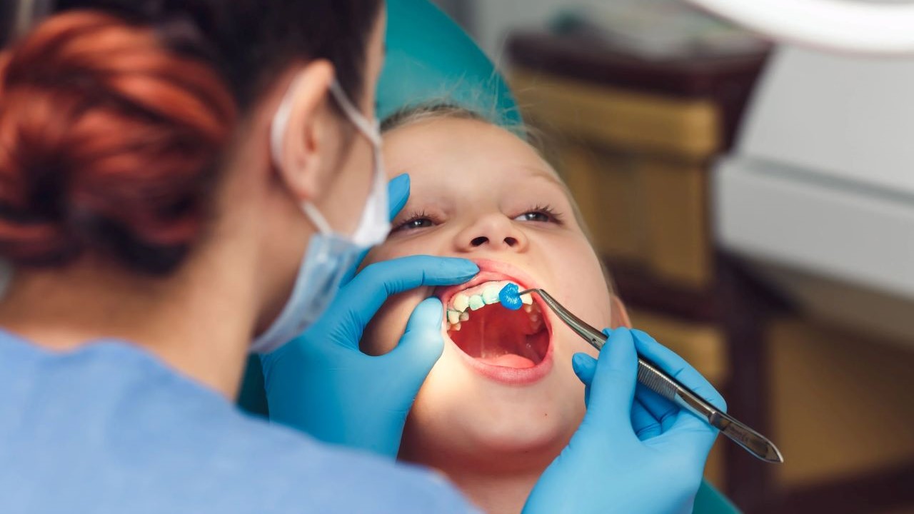 fluor en dientes para prevenir caries