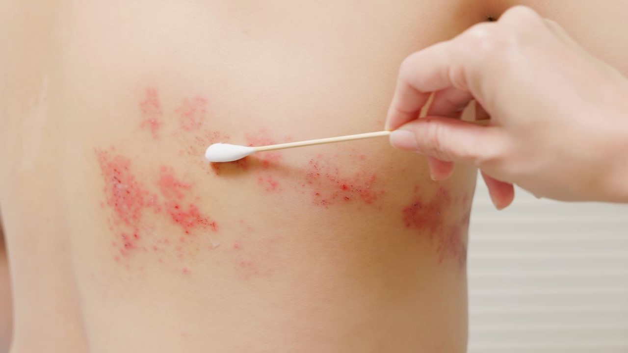 herpes zoster tratamiento para culebrilla en la piel