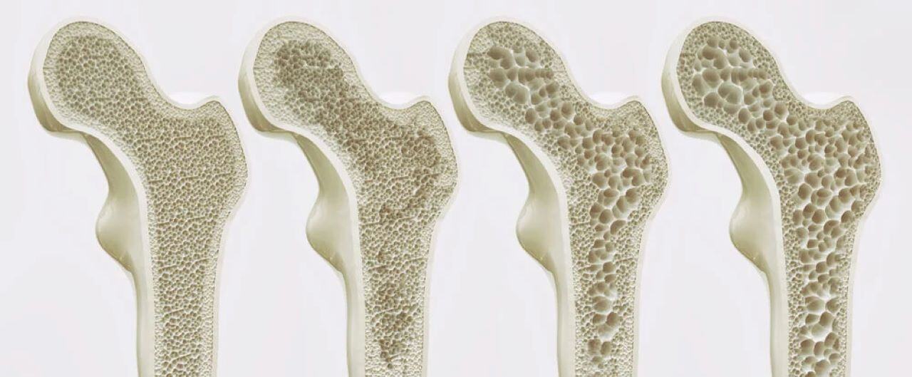 imagenes de osteoporosis cie 10