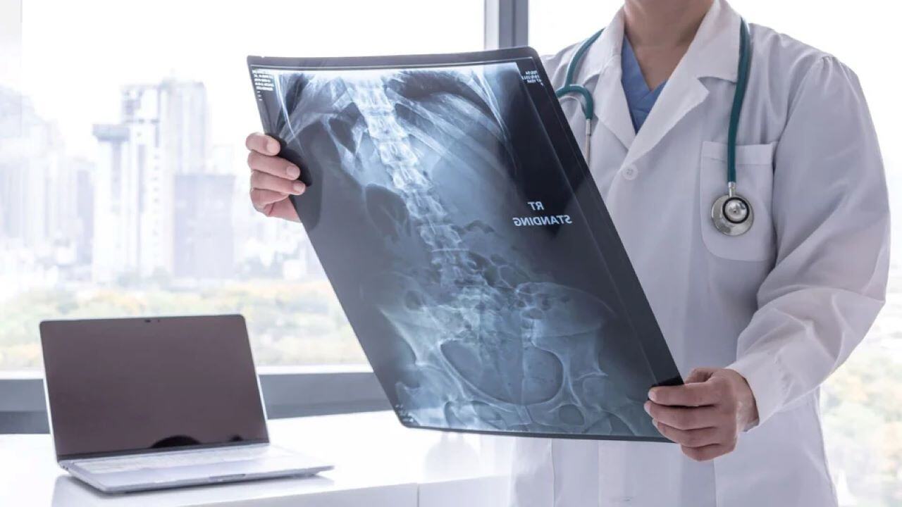la osteopenia es curable tratamiento para la osteopenia