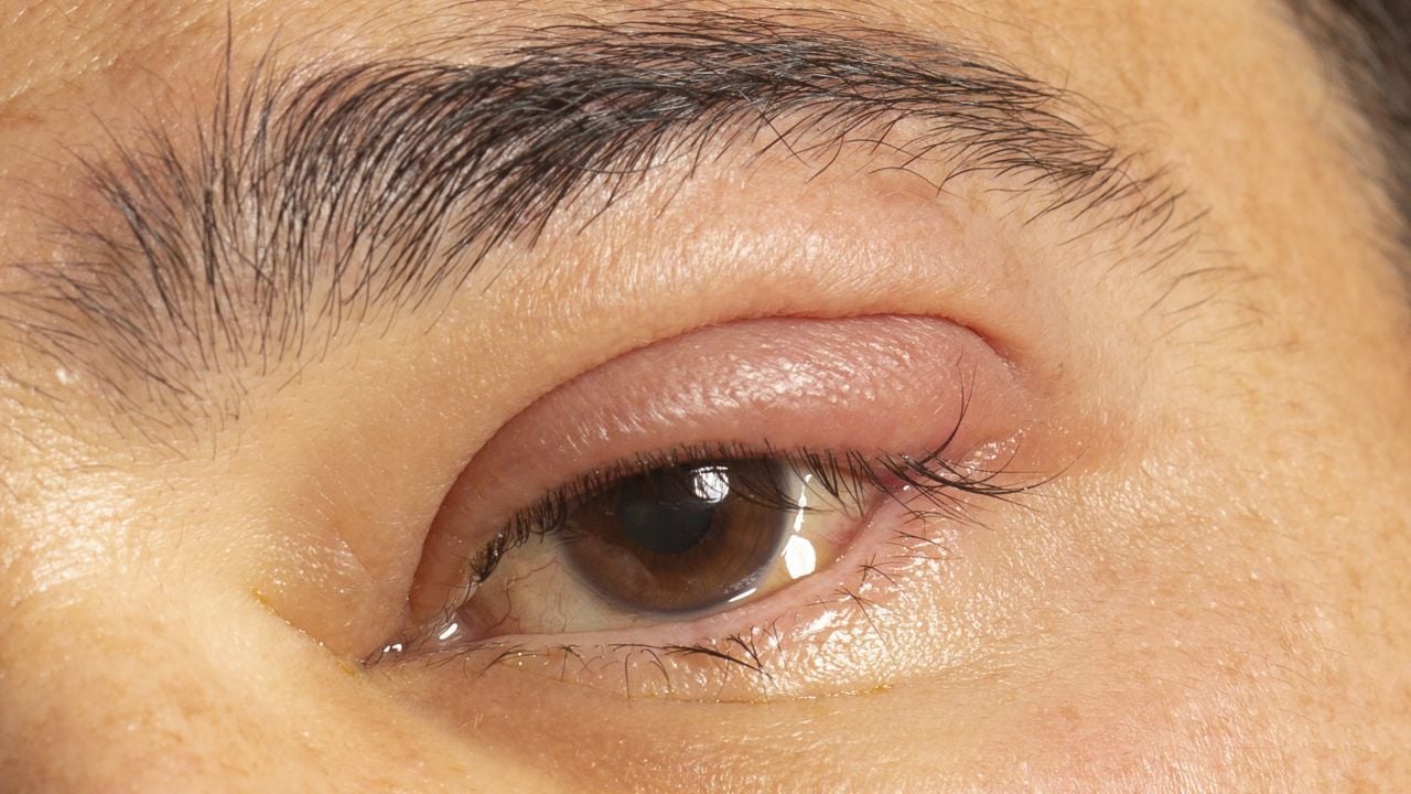 que es chalazion definicion y caracteristicas