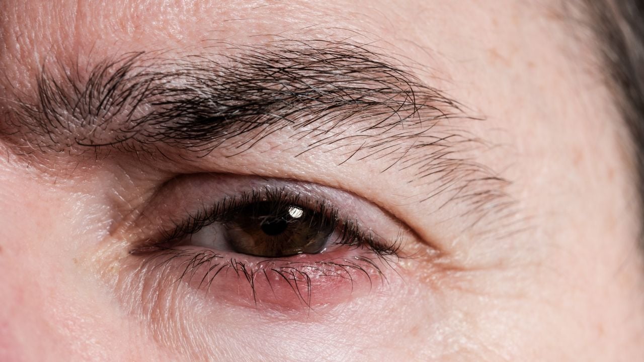 que es orzuelo caracteristicas