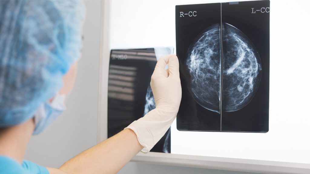 La guía para comprender más sobre la mamografía