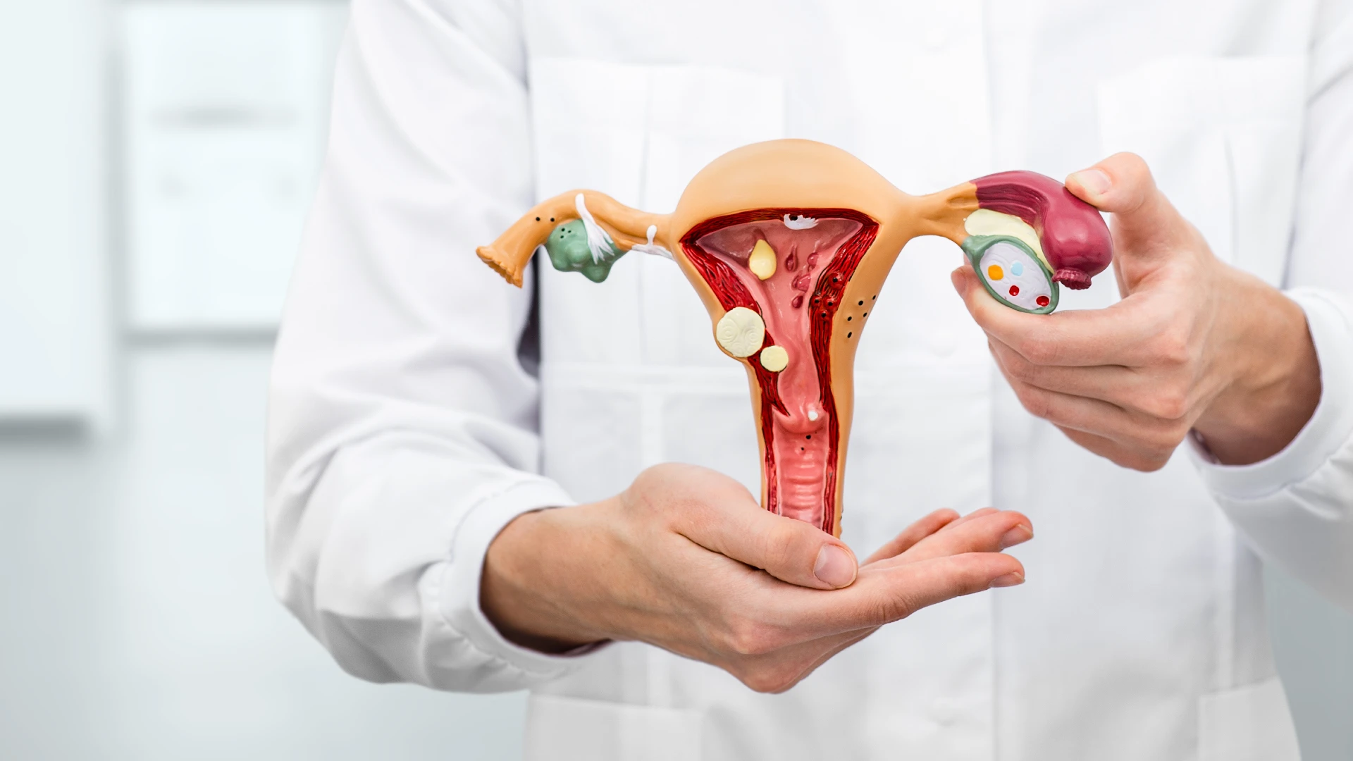 ¿Qué es síndrome de ovario poliquístico? Síntomas y tratamiento